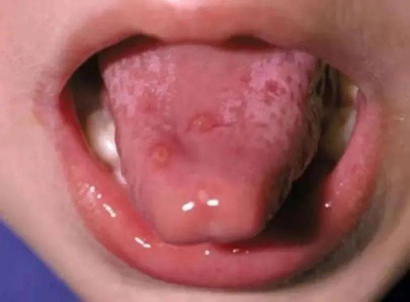 疱疹性咽峡炎手足口病图片