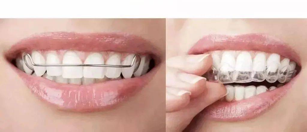 【牙齿矫正】牙齿矫正方法有哪些_牙齿矫正要多久