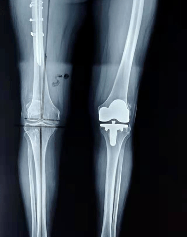 智汇黔南61名医风采黔南州中医医院人工膝关节置换进入人工智能时代