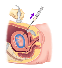 羊膜腔穿刺术俗称羊水穿刺,是进行产前诊断的重要方式,它在超声业导