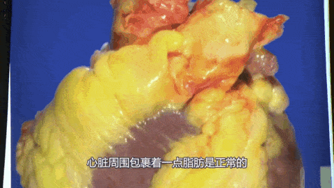 而高糖饮食会增加体内的血脂含量,导致整颗心脏都被脂肪包裹,就算是