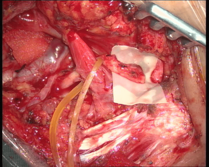 首选:舌下神经降支-面神经吻合术.