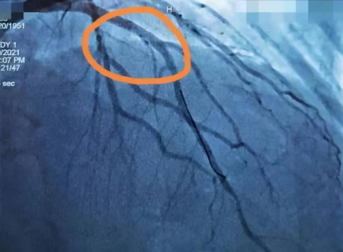 钱大爷|“杠飘，胡啦！”老大爷一激动突发心梗…