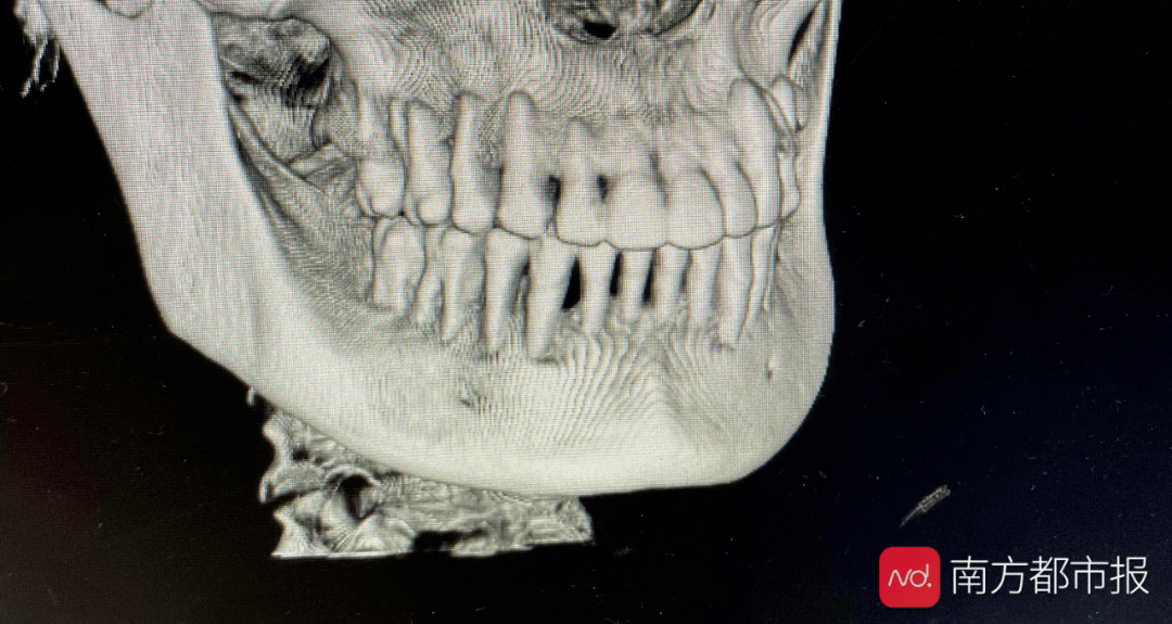 2021年初,習女士前往廣州多家三甲醫院做牙科檢查,發現全口牙槽骨重度