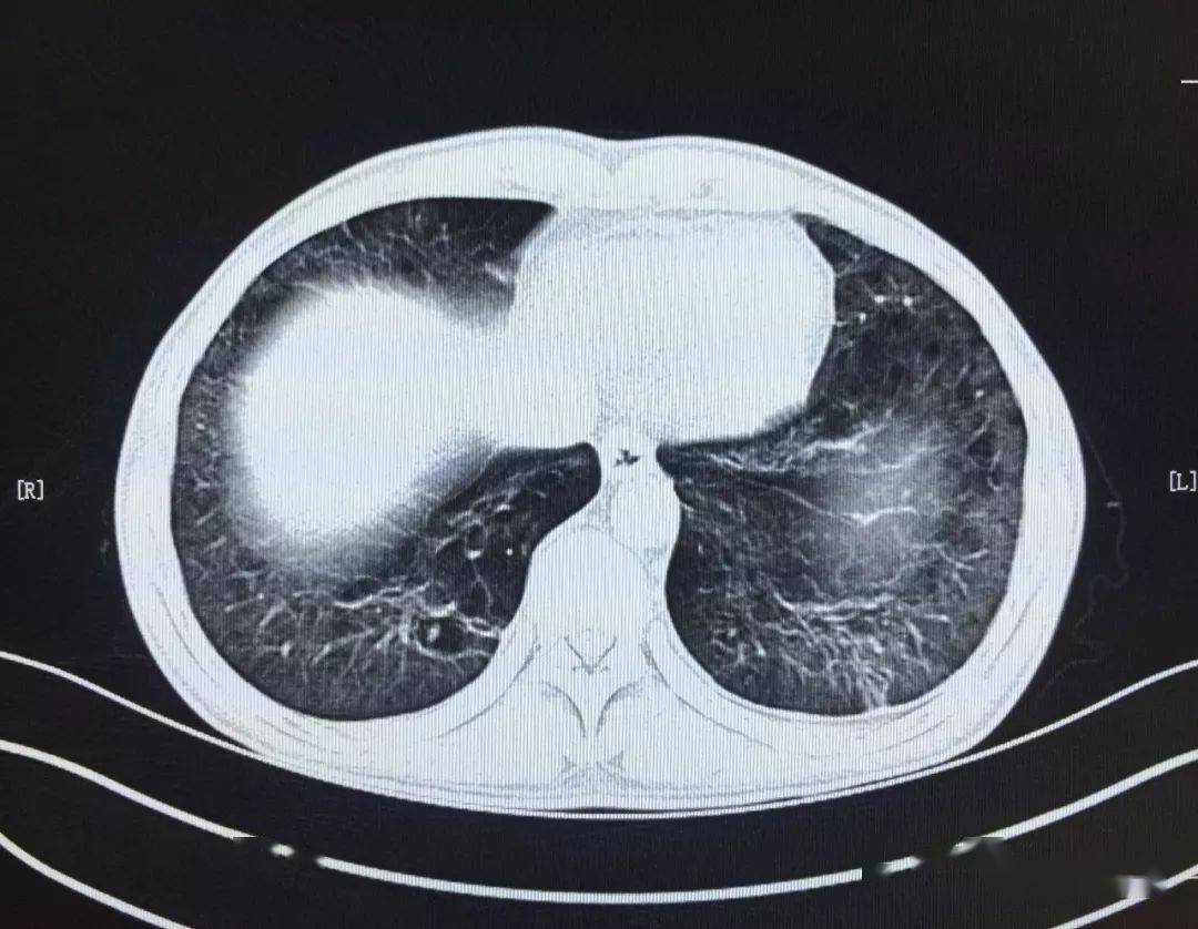 卡氏肺孢子菌肺炎_病史