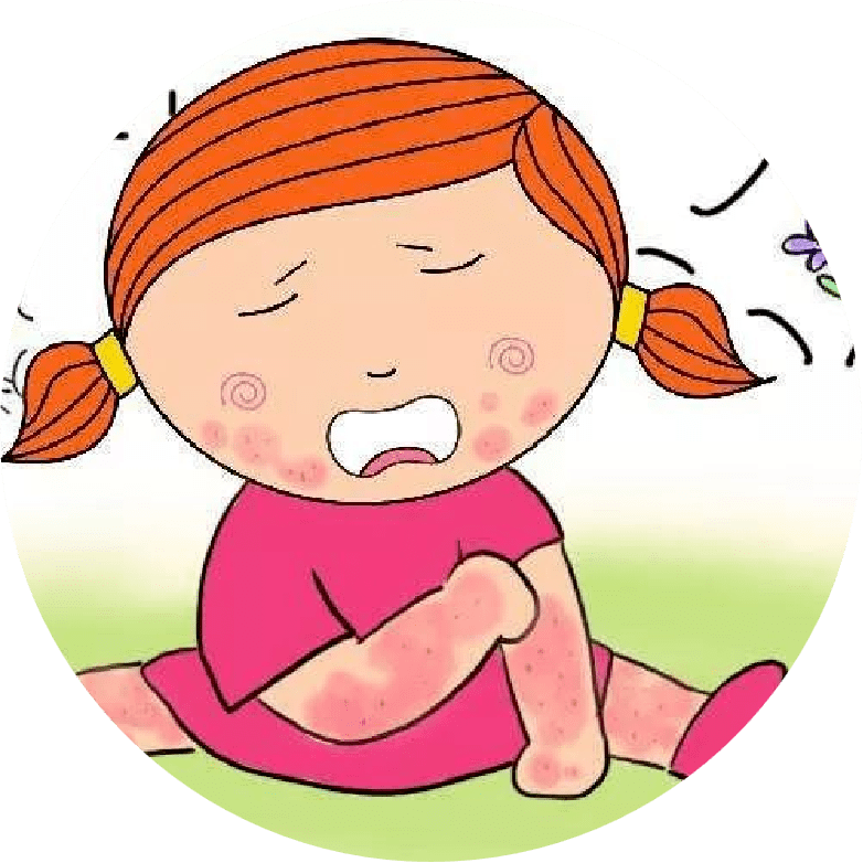 皮肤过敏:有湿疹,药疹,荨麻疹,接触性皮炎等,表现为各类皮疹,大多具有