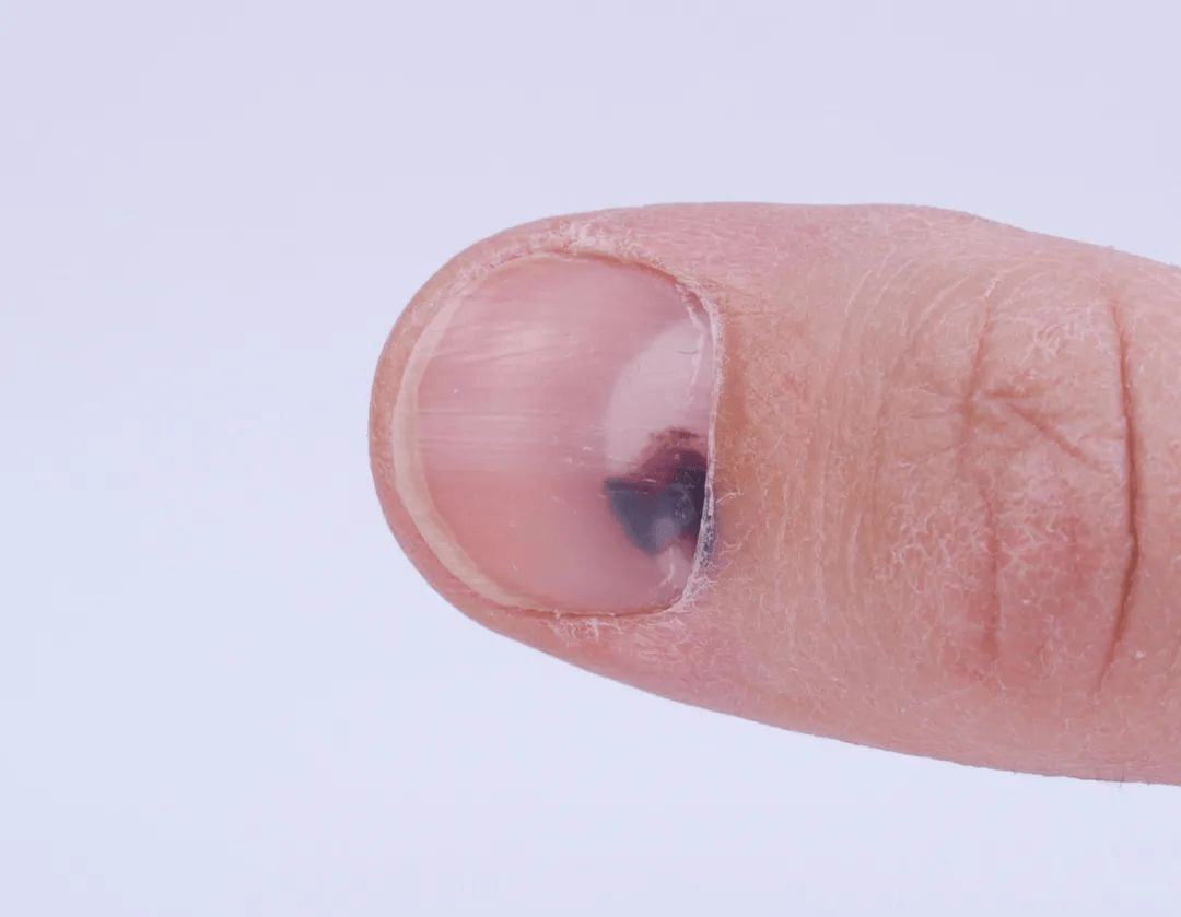 指甲盖疼是癌症（癌症的早期信号指甲）
