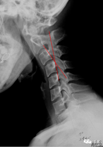 颈椎病解剖经典影像