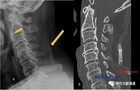 颈椎项韧带钙化图片图片