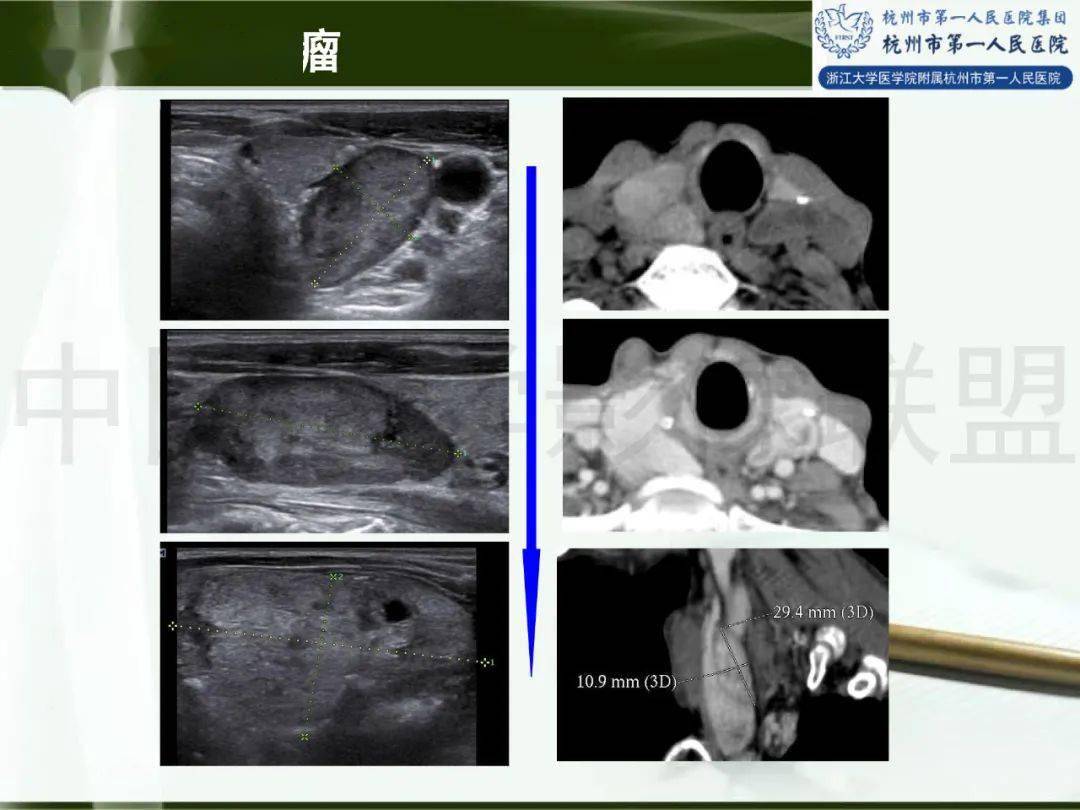 甲状腺ct扫描范围图片
