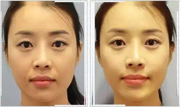 线雕早决定早做早年轻