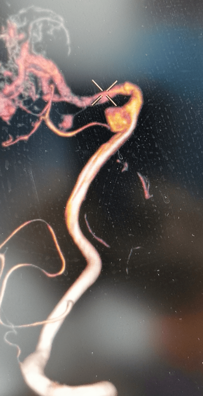 砥砺前行——平度市第三人民医院成功施行首例脑动脉瘤栓塞术_患者