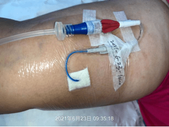 picc 穿刺点并发淋巴漏液,如何处理?