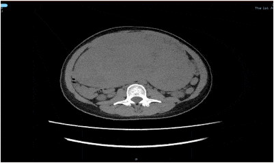 肿瘤|半年微胖8斤，长的不是肉是妇科肿瘤