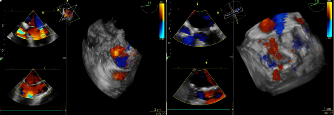 首例超声科成功开展经食管实时三维超声心动图检查