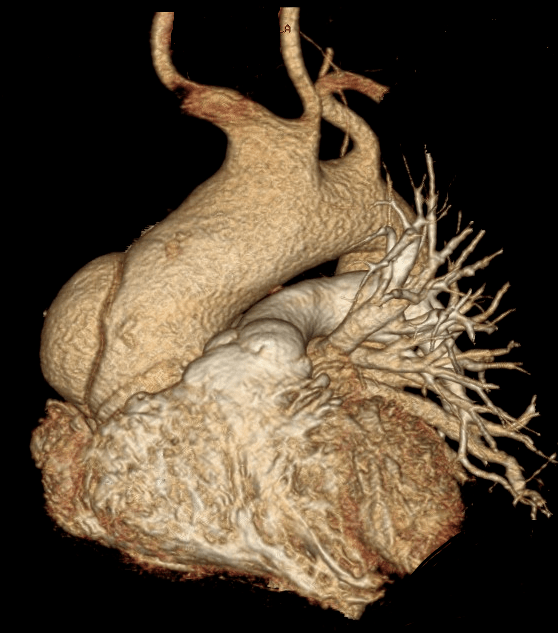 斯坦福a型主动脉夹层