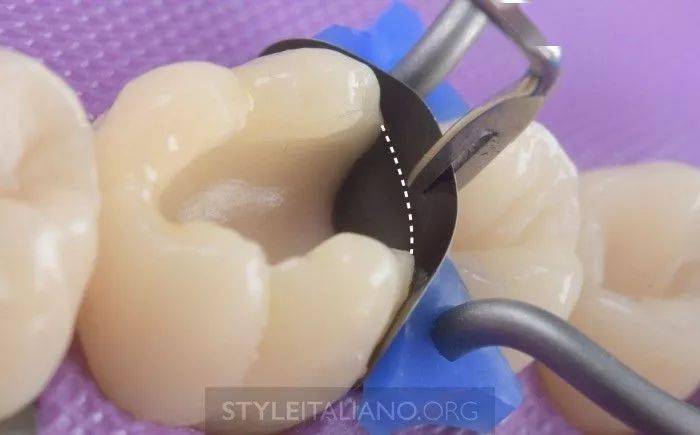 牙医学堂后牙ii类洞邻壁的处理