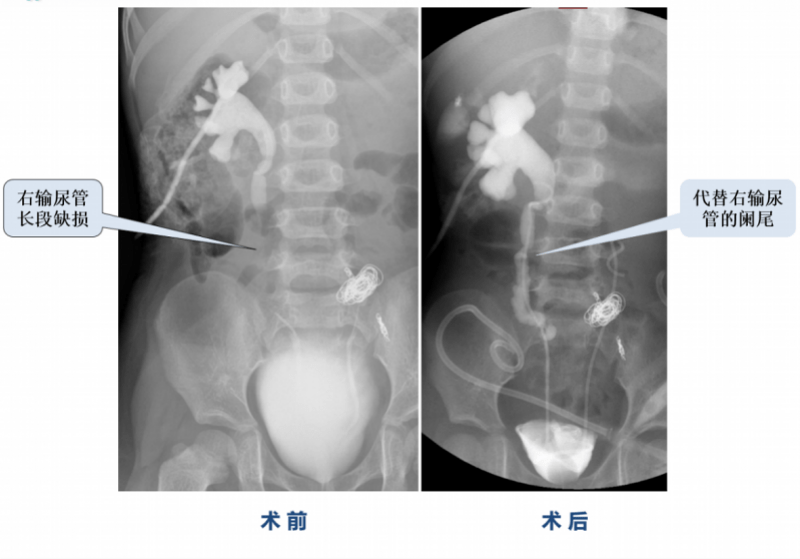 输尿管|华南地区首例！3岁娃输尿管坏死，医生巧用阑尾接好