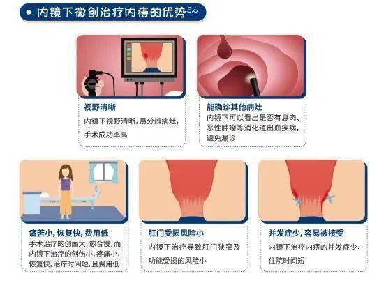 放疗后痔疮疼怎么办