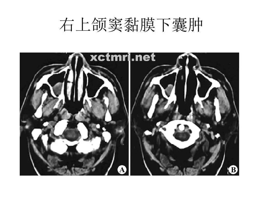 副鼻窦x线解剖图片图片