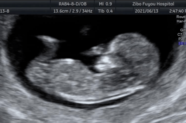 科普视窗丨5个回答让你轻松了解什么是胎儿nt检查