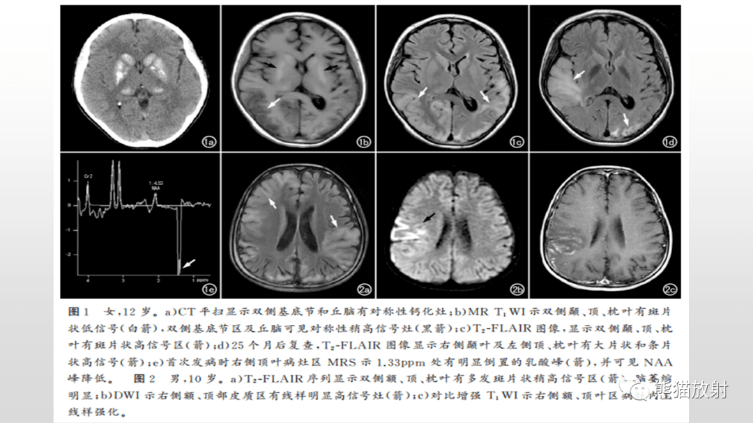 线粒体脑肌病你想到了吗?有收获吗?
