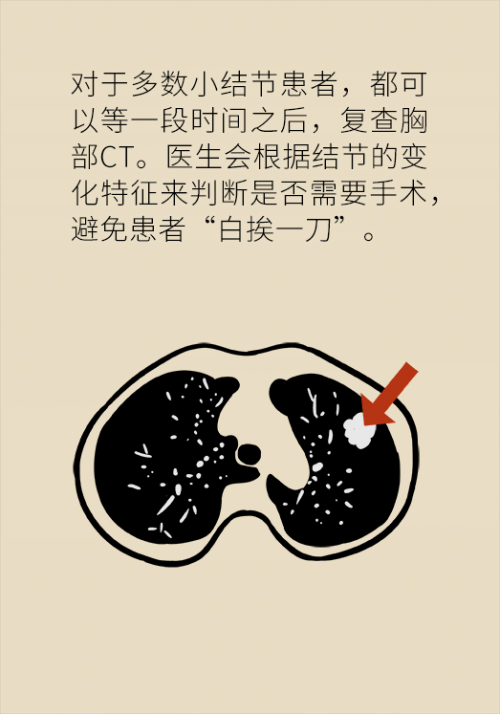 肺部|肺部有6毫米结节用开刀吗？请注意这些关键词