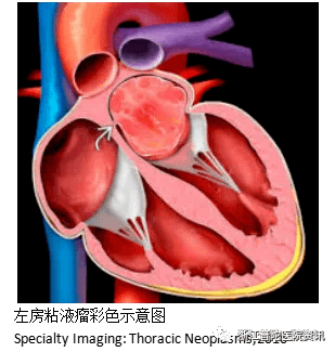 心脏赘生物图片图片