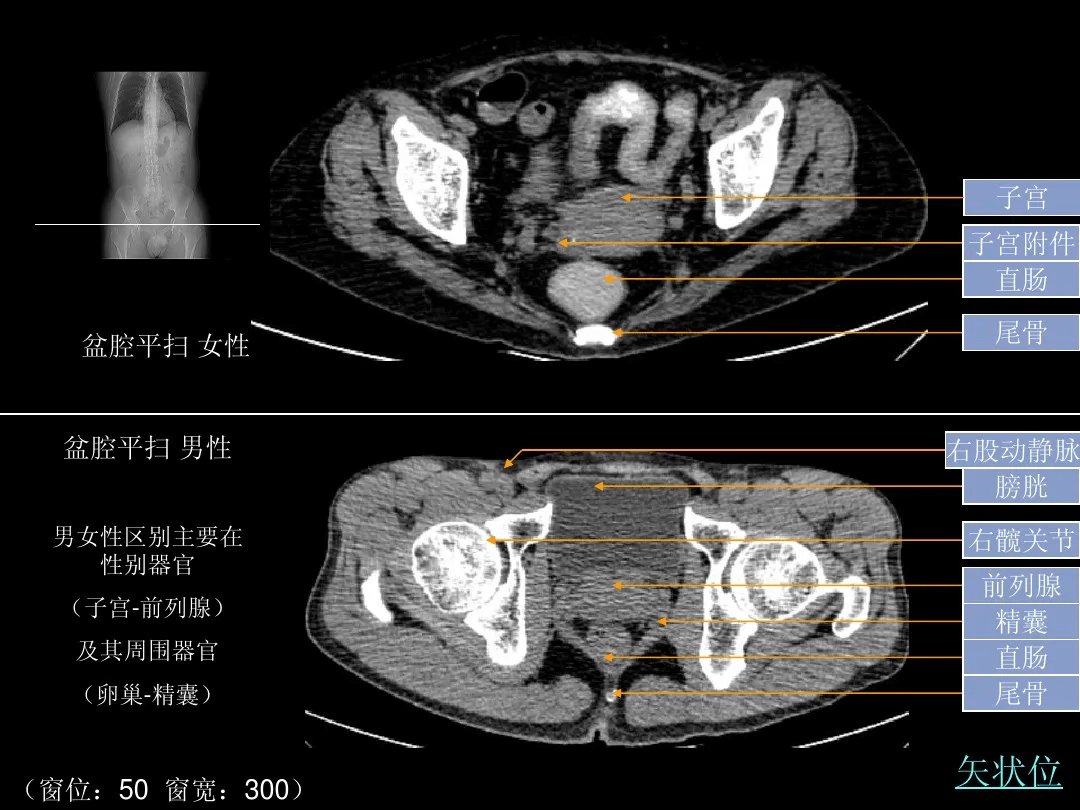 下腹部ct扫描范围图片