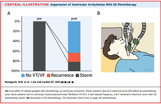 治疗|星状神经节激光或可治顽固性室性心律失常！日本研究