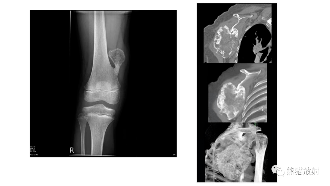 軟骨母細胞瘤 chondroblastoma丨診斷要點軟骨肉瘤丨mri增強掃描診斷