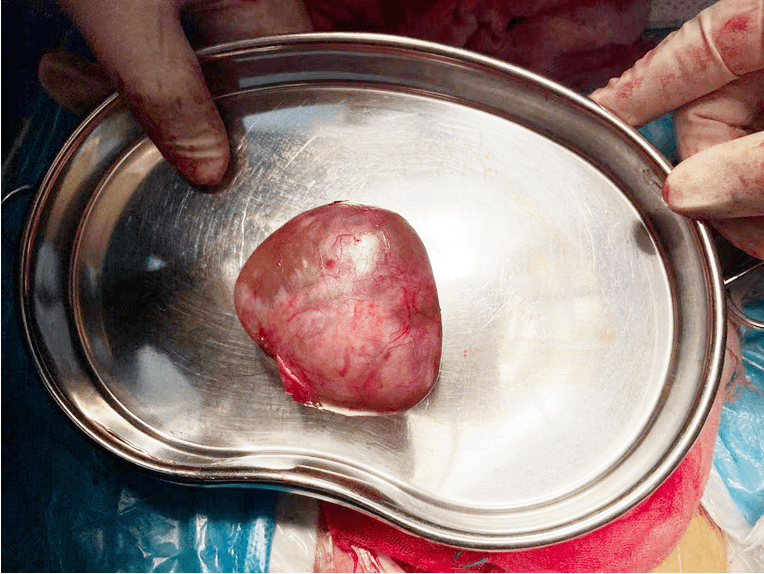 切除的输卵管系膜囊肿腹腔镜手术还是开腹手术?