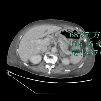 直肠|「放射沙龙Spark病例挑战41期」女性，87岁，因咳嗽气急1周、入院