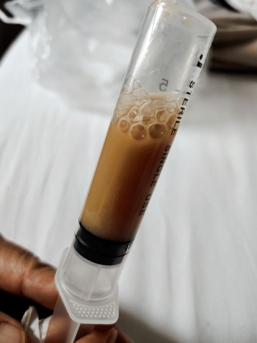 肺切除手术两年后,我的胸腔里流出了"奶茶"_医生