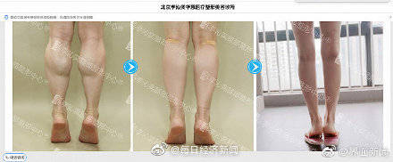 手术|国家卫健委：禁止小腿神经离断瘦腿手术用于临床