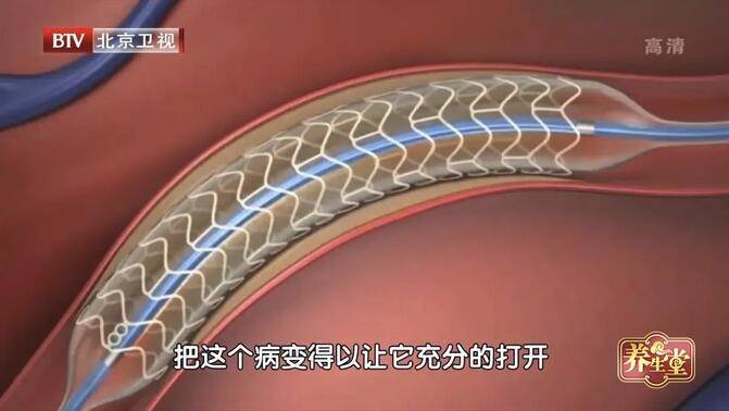 锁骨|一招测试是否有中风危机，赶紧收藏吧！