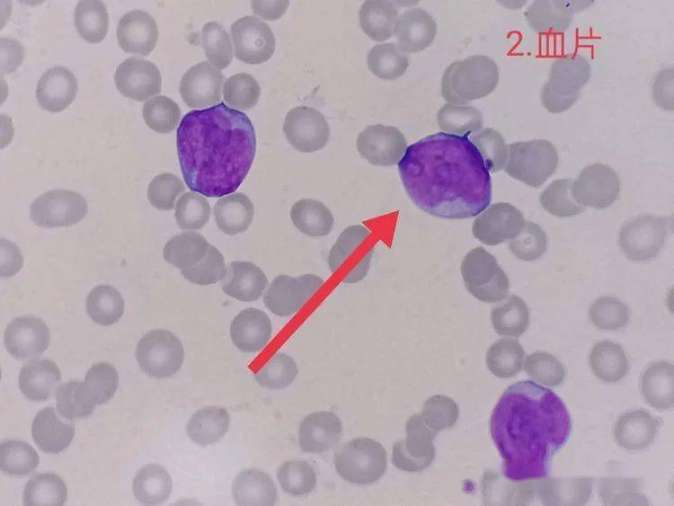胞体内含一巨大包涵体结构,呈紫红色颗粒样,可能为吞噬的细胞核退化