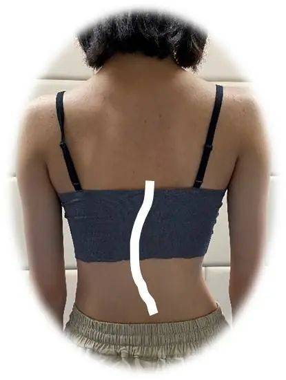 角度|简单辨别脊柱侧弯，避免孩子走“弯”路！