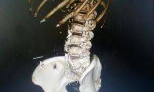 部位|这事儿真不能做！阿婆在家自己扎针灸，结果针断进腹中