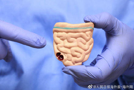技术|日本研发出用唾液检测大肠癌技术