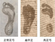 身体状况|全民健身日：医学专家教你科学跑步，不同足弓选择跑鞋有讲究
