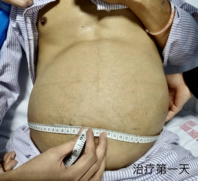 大肚子|心脏瓣膜病变竟催生出个超级大肚腩，心衰也能引起腹部膨胀