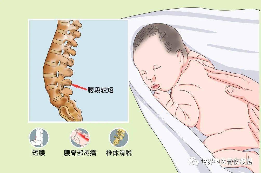 疾病分类可分为三类:先天性脊椎崩裂,滑脱,先天性椎体融合,半椎体畸形