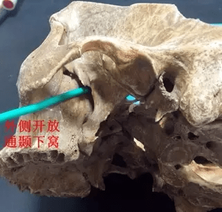 翼腭窝的ct影像解剖