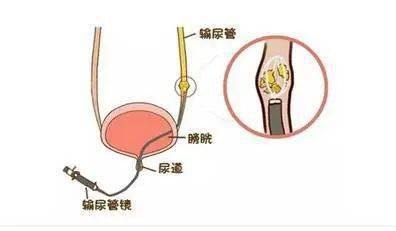 目前有4种治疗方法:(3)经输尿管镜碎石取石术,适用于输尿管结石.