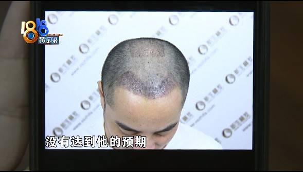 效果|90后“新生植发” 两年后“又见稀疏”