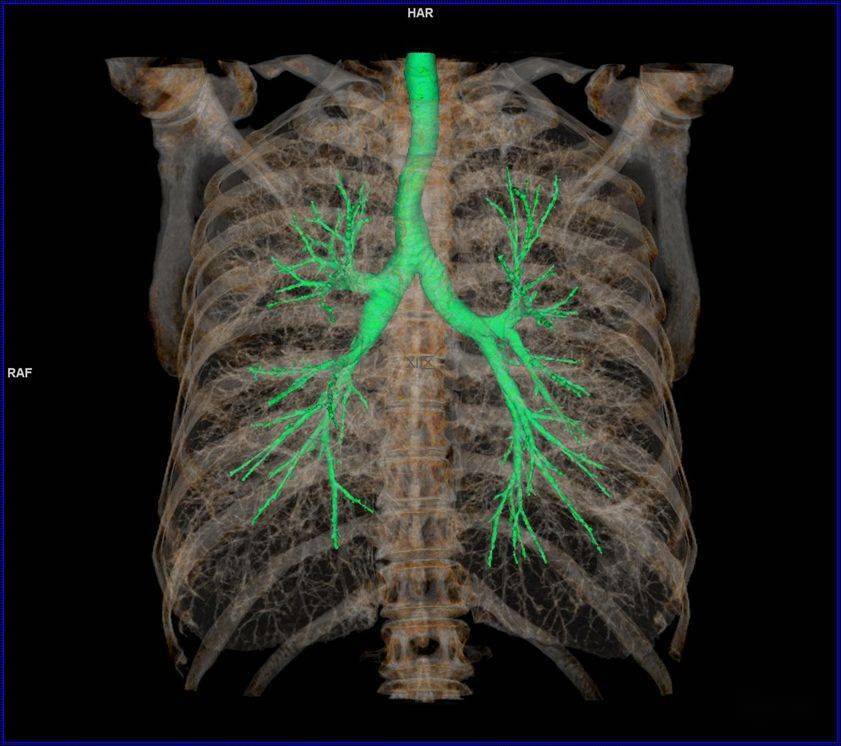 右肺支气管三维图图片