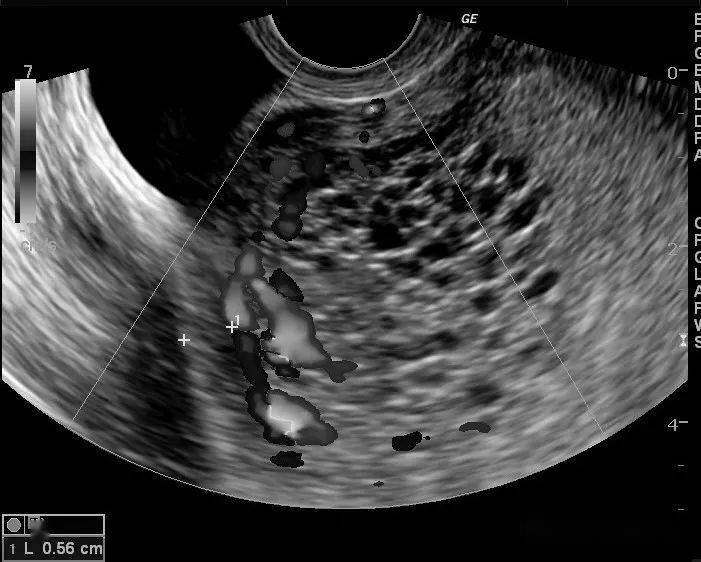 葡萄胎超声图片大全图片