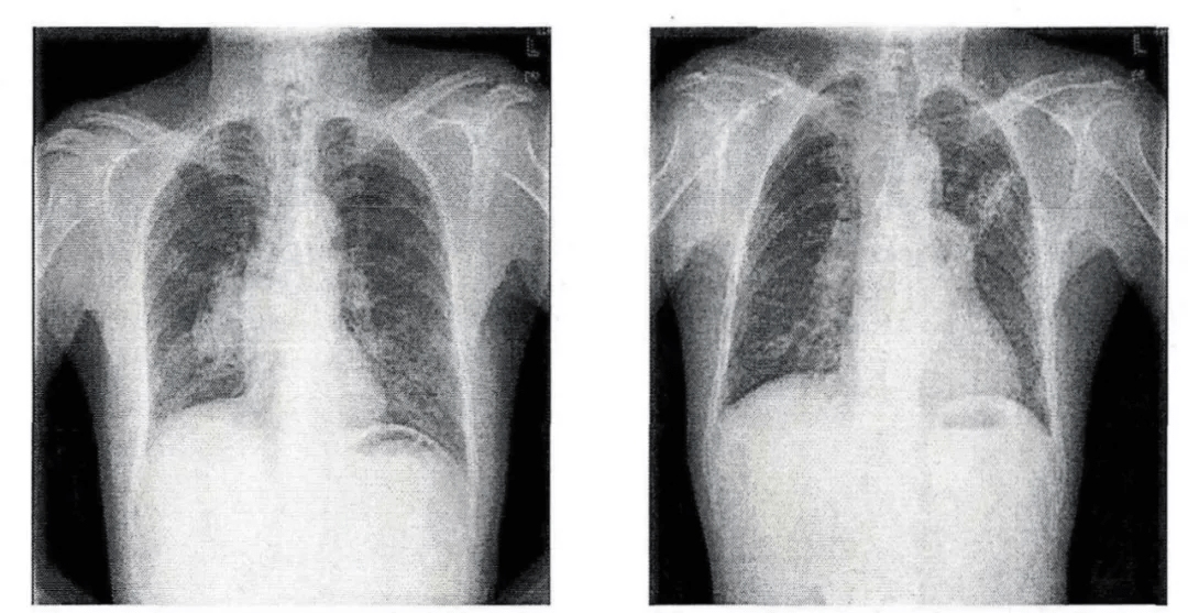 这样的充盈缺损是肺栓塞
