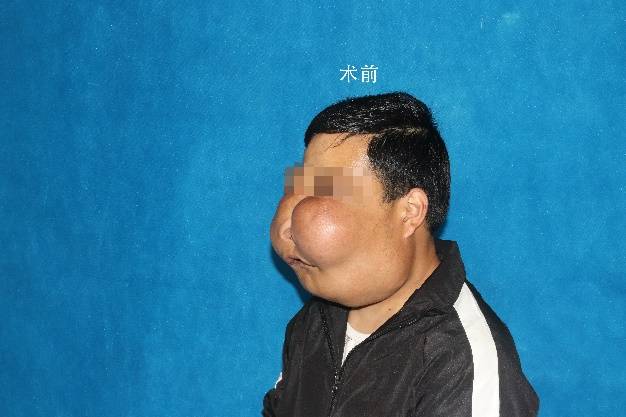 颌面|29岁男子长“河马脸”被当怪物，两次手术“改写人生”